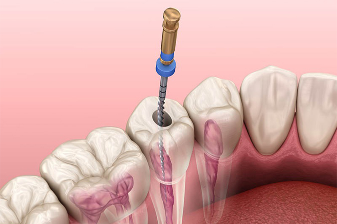 Endodontics