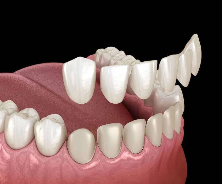 Veneers