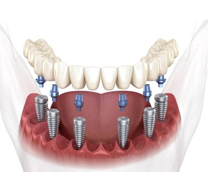 Full Fixed Denture