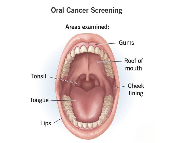 Oral Cancer Screening