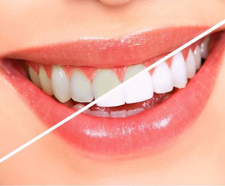 Teeth Whitening