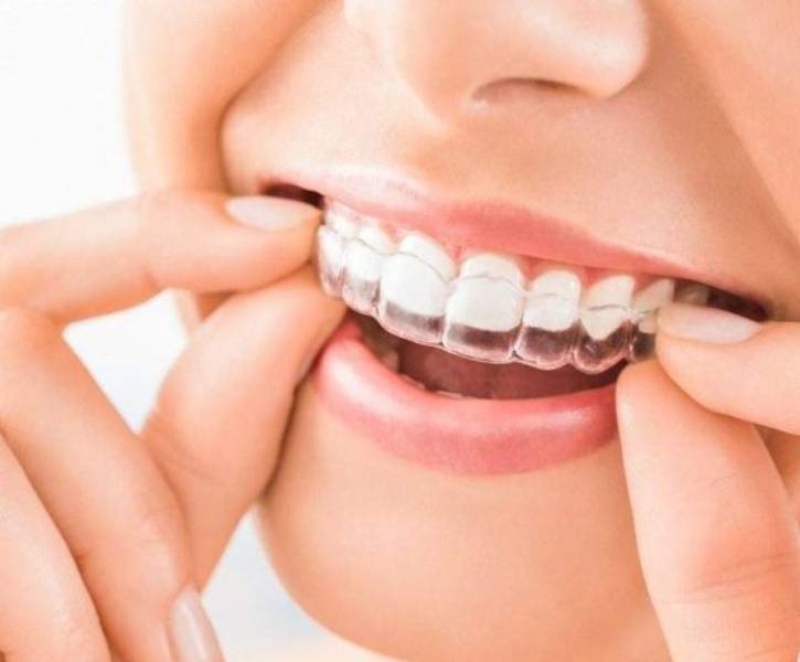Transparent Braces