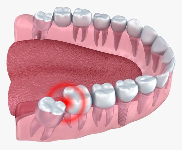 Wisdom Tooth Removal